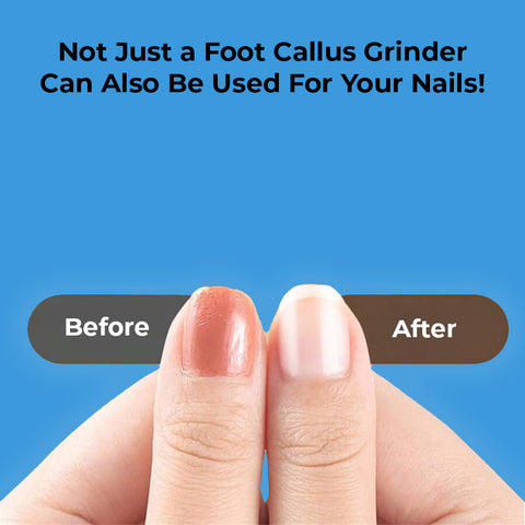 Electric Foot File - Foot Callus Remover