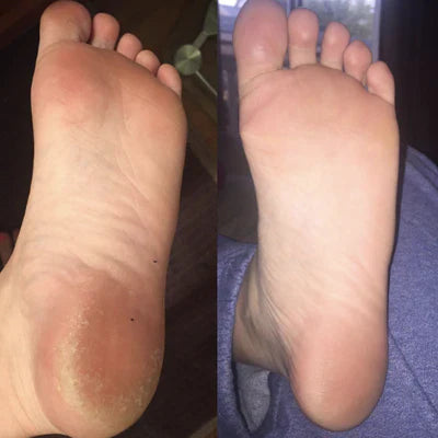 Callus Remover for feet